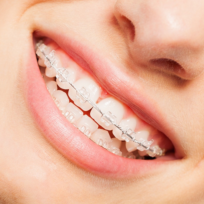 invisible aligners or braces