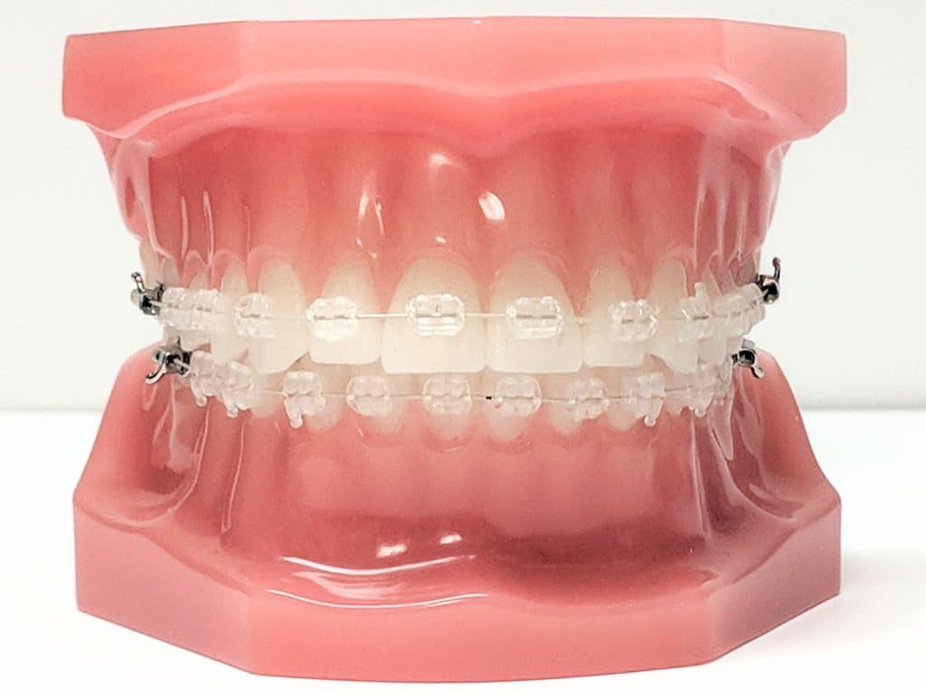Teeth Aligners vs. Clear Braces: What's the Difference?