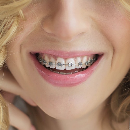 Blonde Young Woman With Braces Smiling True Orthodontics
