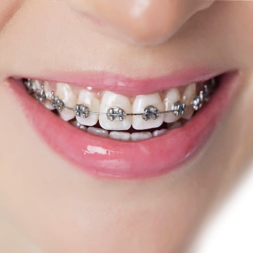 metal-braces | True Orthodontics, PC