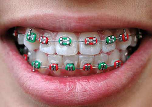 using rubber bands to straighten teeth