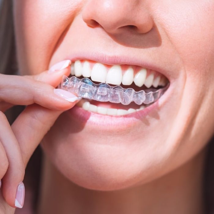 Invisalign, Invisalign Cost